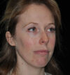 Rhinoplasty case #15242