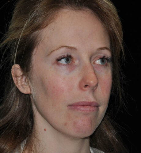 Rhinoplasty case #15242