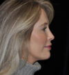 Rhinoplasty case #15242