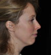 Rhinoplasty case #15242