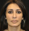 Rhinoplasty case #15235