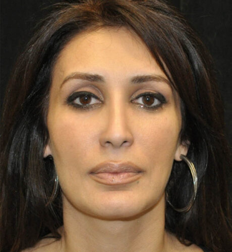 Rhinoplasty case #15235