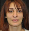 Rhinoplasty case #15235
