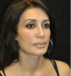 Rhinoplasty case #15235