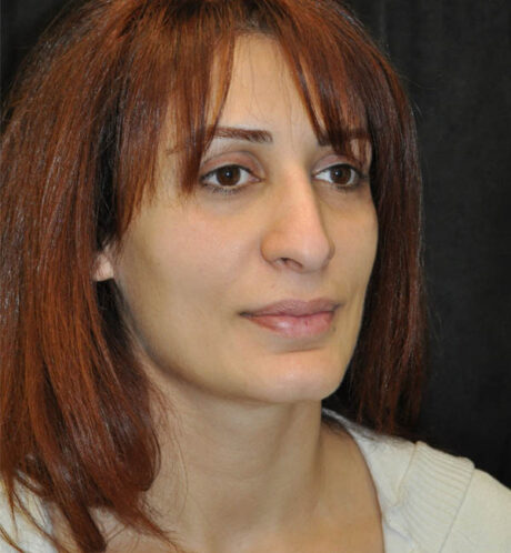 Rhinoplasty case #15235