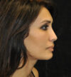 Rhinoplasty case #15235