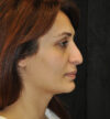 Rhinoplasty case #15235