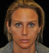 Rhinoplasty case #15230