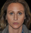 Rhinoplasty case #15230