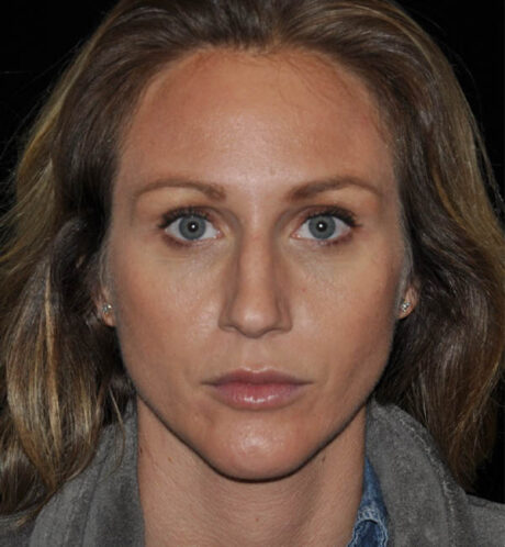 Rhinoplasty case #15230