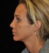 Rhinoplasty case #15230