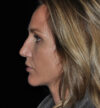Rhinoplasty case #15230