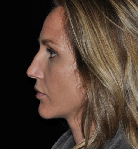Rhinoplasty case #15230
