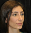 Rhinoplasty case #15225