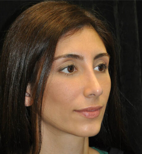 Rhinoplasty case #15225