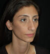Rhinoplasty case #15225
