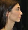 Rhinoplasty case #15225