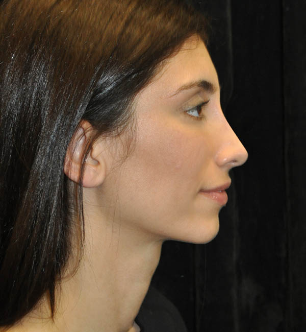 Rhinoplasty case #15225