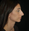 Rhinoplasty case #15225