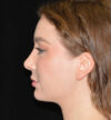 Rhinoplasty case #15222