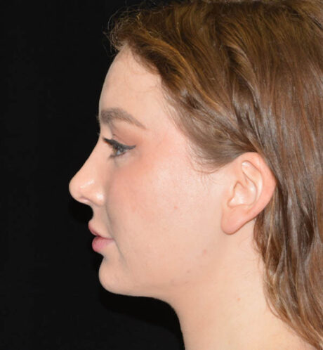 Rhinoplasty case #15222