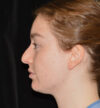 Rhinoplasty case #15222