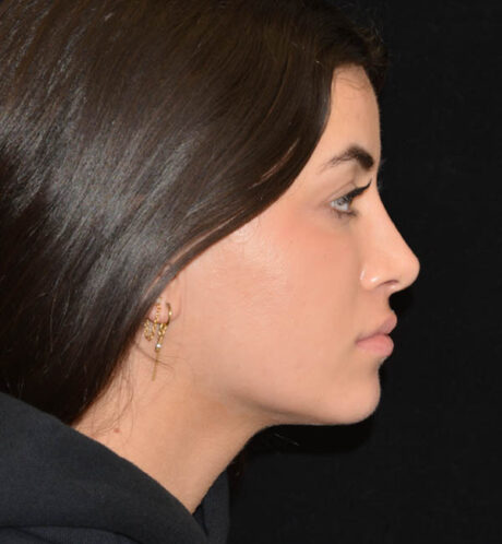 Rhinoplasty case #15219