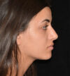 Rhinoplasty case #15219