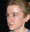 Rhinoplasty case #15212