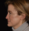 Rhinoplasty case #15212