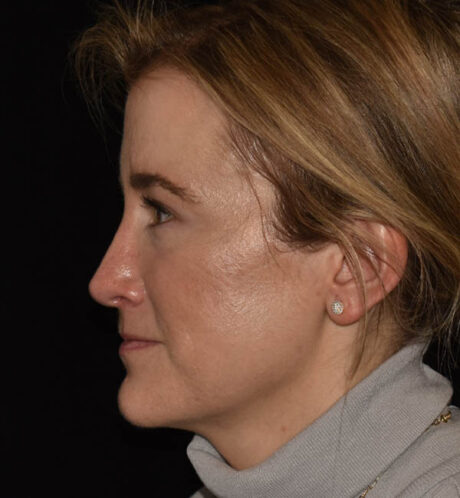 Rhinoplasty case #15212