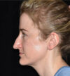Rhinoplasty case #15212