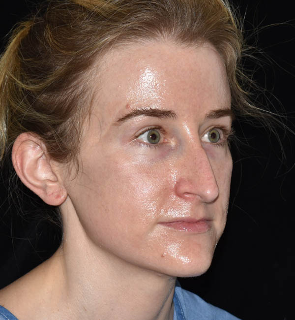 Rhinoplasty case #15212