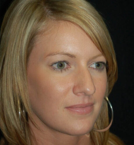 Rhinoplasty case #15207