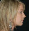 Rhinoplasty case #15207