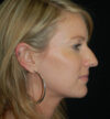 Rhinoplasty case #15207