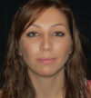 Rhinoplasty case #15200