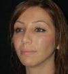 Rhinoplasty case #15200
