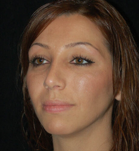 Rhinoplasty case #15200