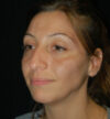 Rhinoplasty case #15200