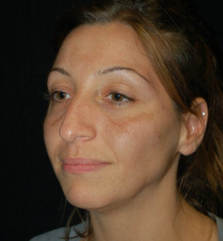 Rhinoplasty case #15200