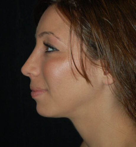 Rhinoplasty case #15200