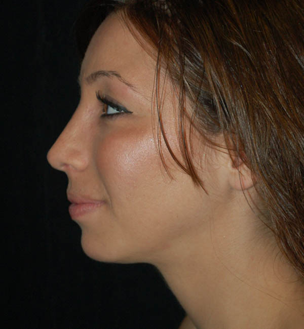 Rhinoplasty case #15200