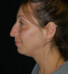 Rhinoplasty case #15200