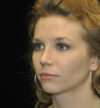 Rhinoplasty case #15195