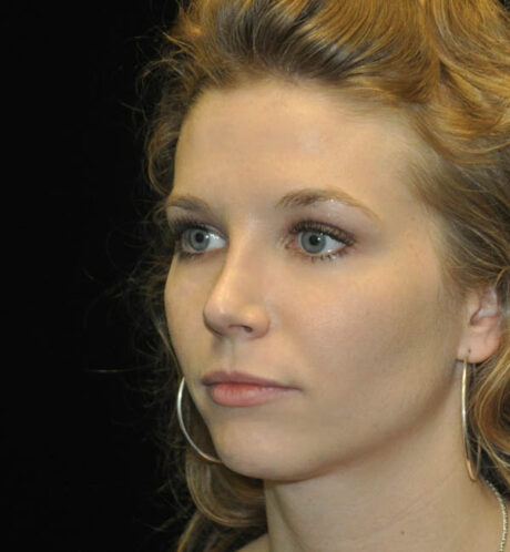 Rhinoplasty case #15195