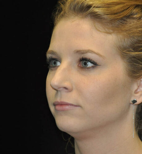 Rhinoplasty case #15195