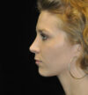 Rhinoplasty case #15195