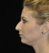 Rhinoplasty case #15195