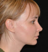 Rhinoplasty case #15192